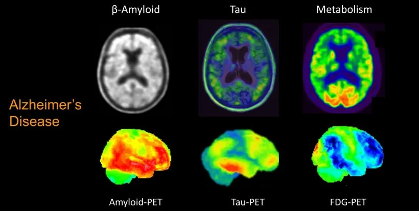 PET molecular imaging of a patient with AD Dementia